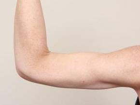 after arm lift left arm back view case 3464