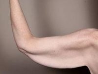 before arm lift left arm back view case 3464