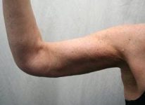 after arm lift left arm front view case 3469