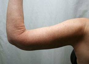 after arm lift left arm view case 3469