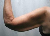 before arm lift left arm view case 3469