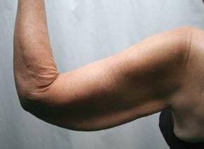 before arm lift left arm view case 3469