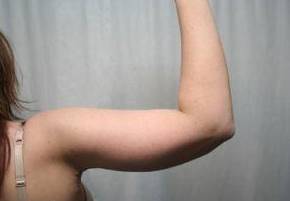 after arm lift right arm view case 3474