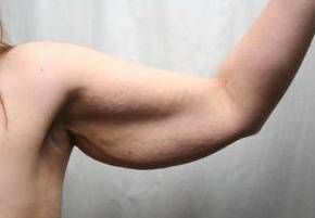 before arm lift right arm view case 3474