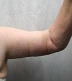 after arm lift right arm front view case 3477