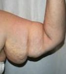 before arm lift right arm front view case 3477