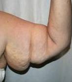 before arm lift right arm front view case 3477