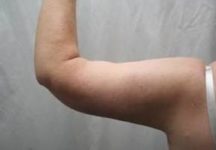 after arm lift left arm back view case 3477