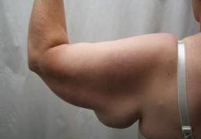 before arm lift left arm back view case 3477