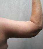 after arm lift right arm back view case 3477