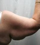 before arm lift right arm back view case 3477