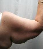 before arm lift right arm back view case 3477