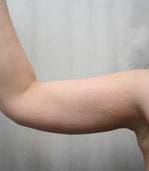 after arm lift front left arm case 3484