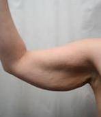 before arm lift front left arm case 3484