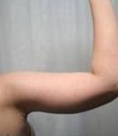 after arm lift right arm case 3484