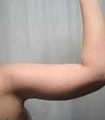 after arm lift right arm case 3484