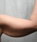 before arm lift right arm case 3484