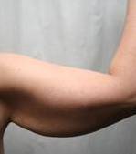 before arm lift right arm case 3484