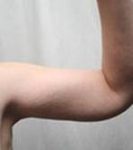 after arm lift right arm view case 3489