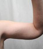 after arm lift right arm view case 3489
