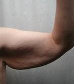 before arm lift right arm view case 3489