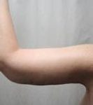 after arm lift left arm view case 3489