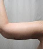 after arm lift left arm view case 3489