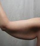 before arm lift left arm view case 3489