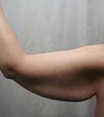 before arm lift left arm view case 3489