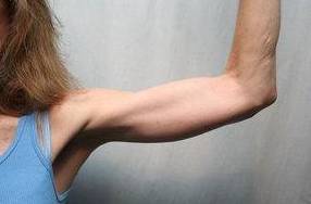 after arm lift front view case 3494 | Chapin Aesthetics