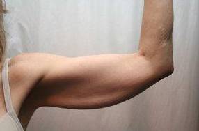 before arm lift front view case 3494 | Chapin Aesthetics