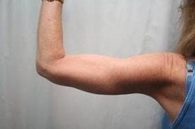 after arm lift back view case 3494 | Chapin Aesthetics