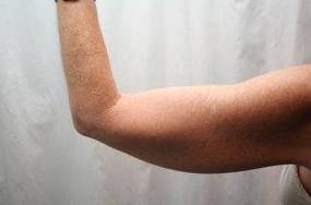 before arm lift back view case 3494 | Chapin Aesthetics