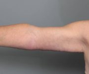 after arm lift front view case 3500 | Chapin Aesthetics