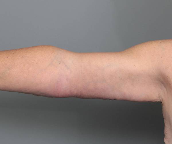 after arm lift front view case 3500 | Chapin Aesthetics