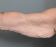 before arm lift front view case 3500 | Chapin Aesthetics
