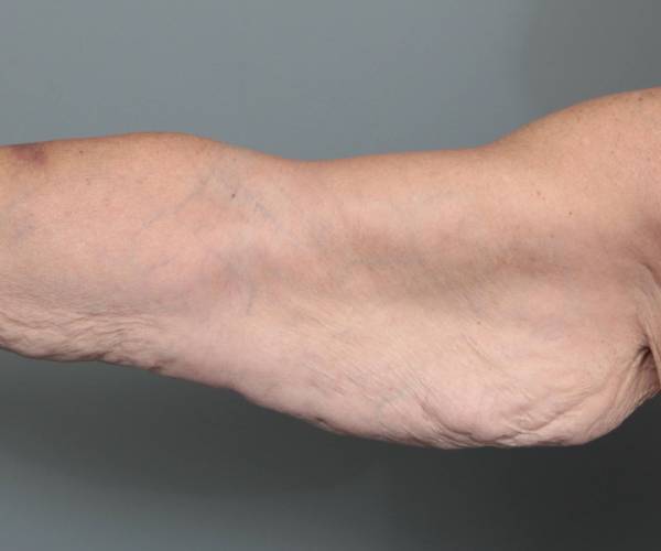 before arm lift front view case 3500 | Chapin Aesthetics