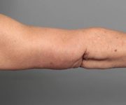 after arm lift arm extended view case 3500 | Chapin Aesthetics
