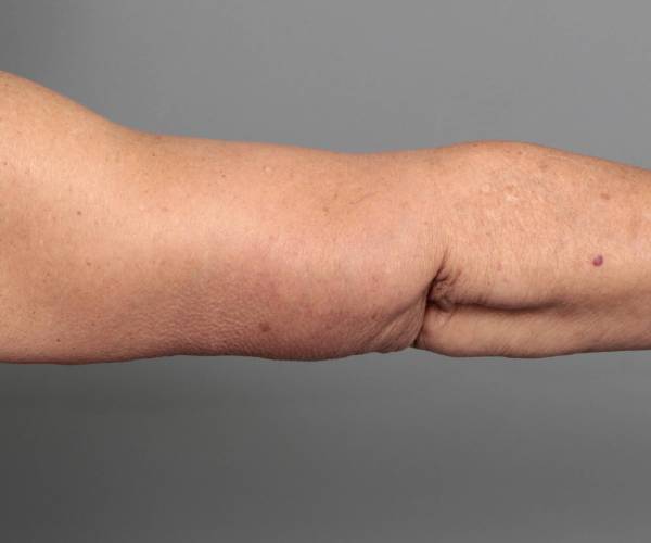 after arm lift arm extended view case 3500 | Chapin Aesthetics