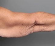 before arm lift arm extended view case 3500 | Chapin Aesthetics
