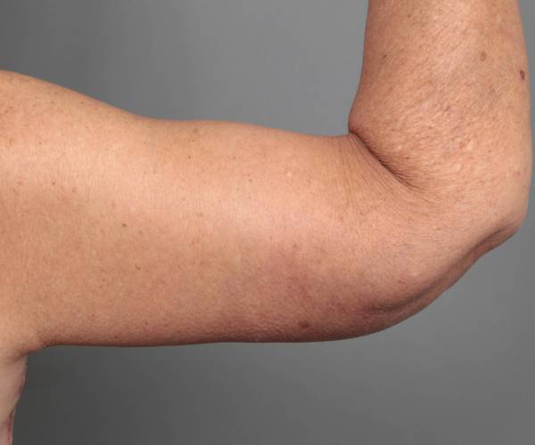 after arm lift back view case 3500 | Chapin Aesthetics