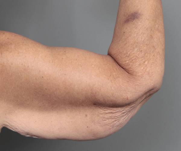 before arm lift back view case 3500 | Chapin Aesthetics