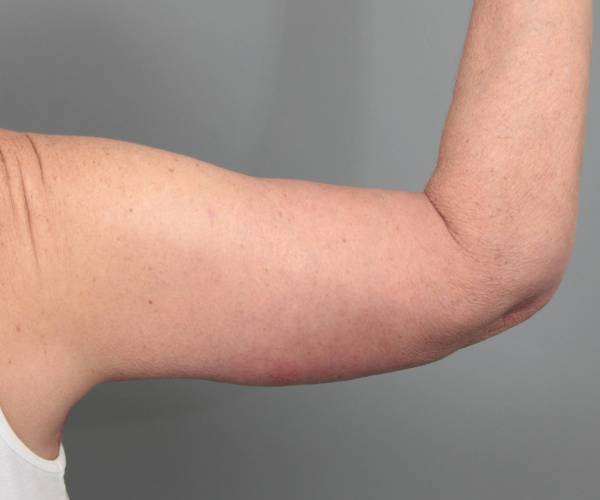after arm lift back view case 3507 | Chapin Aesthetics