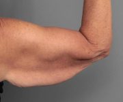 before arm lift back view case 3507 | Chapin Aesthetics