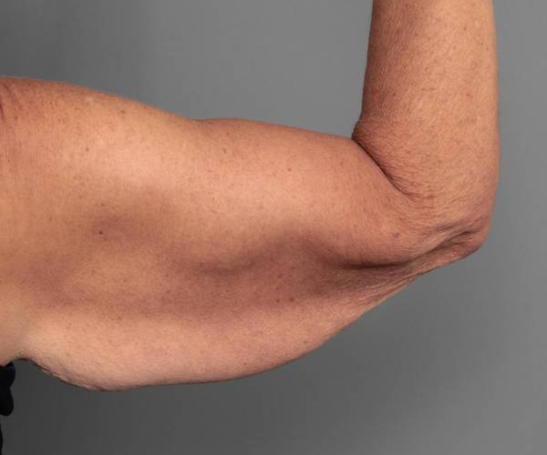 before arm lift back view case 3507 | Chapin Aesthetics