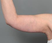 after arm lift front view case 3507 | Chapin Aesthetics