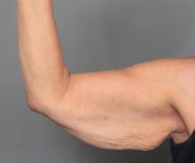 before arm lift front view case 3507 | Chapin Aesthetics