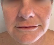before bbl moxi front view female patient case 2972