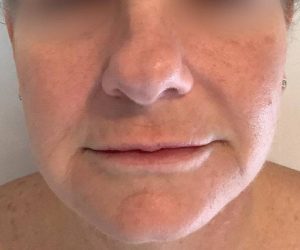 before bbl moxi front view female patient case 2972