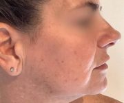before bbl moxi right side view female patient case 2972